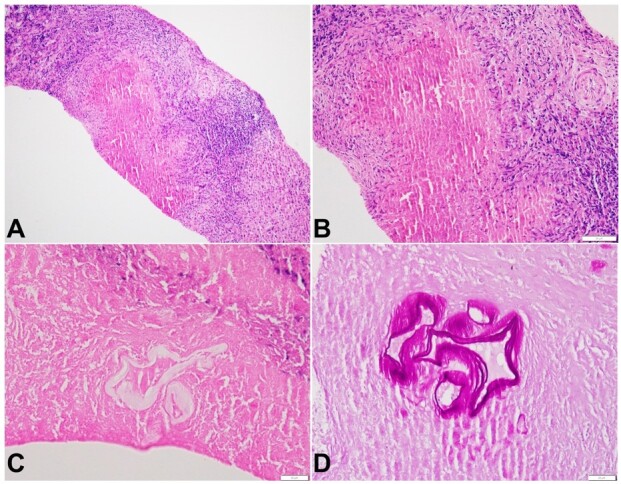 Hepatic alveolar echinococcosis simulating metastatic malignancy.