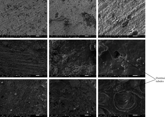 Comparative Evaluation of Antimicrobial and Smear Layer Removal Efficacy of <i>Mangifera indica</i> Kernel Extract as Root Canal Irrigant in Primary Molar: An In Vitro Study.