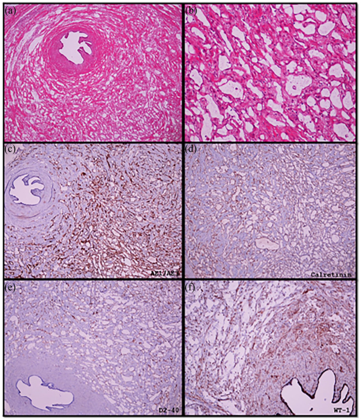 The Incidental Diagnosis of Adenomatoid Tumour on Fallopian Tubes Submitted for Tubal Ligation at a Tertiary Laboratory in Northern Pretoria, South Africa.