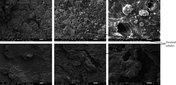 Comparative Evaluation of Antimicrobial and Smear Layer Removal Efficacy of <i>Mangifera indica</i> Kernel Extract as Root Canal Irrigant in Primary Molar: An In Vitro Study.
