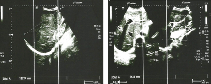 [Hepatosplenic sarcoidosis: description of a case at the University hospital center of Brazzaville, Congo].