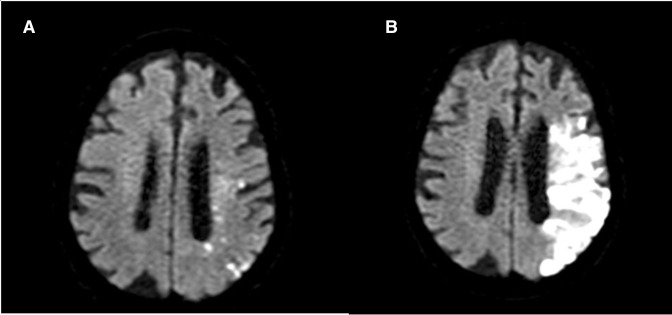 Early anticoagulation in patients with stroke and atrial fibrillation is associated with fewer ischaemic lesions at 1 month: the ATTUNE study.