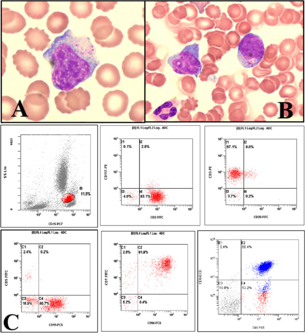 Peripheral T-cell lymphoma, NOS in bone marrow and heart.