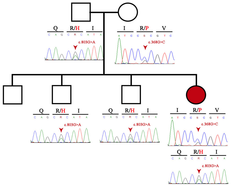 Familial LCAT Deficiency and Low HDL-C Levels: In silico Characterization of Two Rare LCAT Missense Mutations.