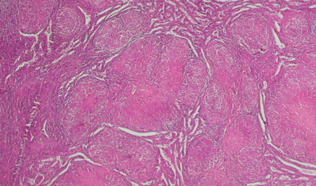[Hepatosplenic sarcoidosis: description of a case at the University hospital center of Brazzaville, Congo].