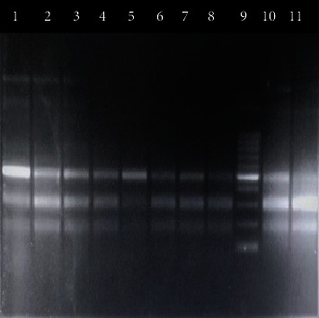 Association of Cytokine IL-17, IL-4, IL-6, and IL-12 Gene Polymorphisms in Rheumatoid Arthritis Patients in a Tertiary Care Hospital in Bangladesh.