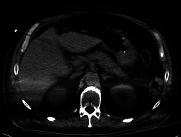 Upper Gastrointestinal Bleeding Secondary to Sodium Polystyrene Sulfonate Use: A Rare Adverse Effect of Commonly Prescribed Treatment.
