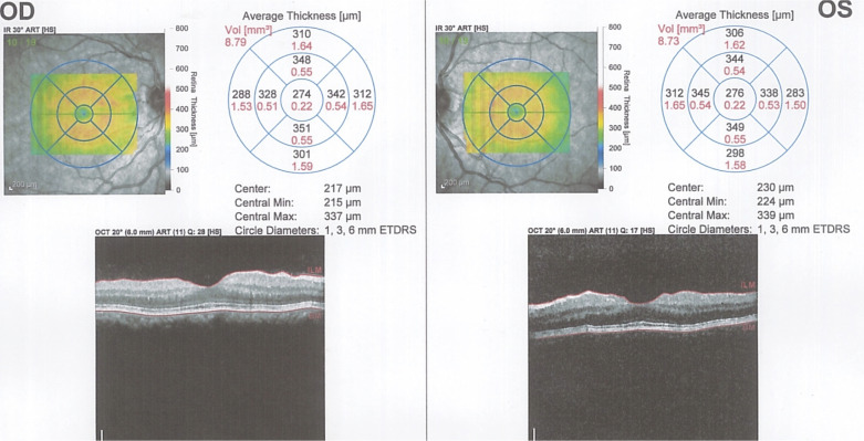 Transient Myopia and Ciliochoroidal Effusion following Influenza Vaccination.