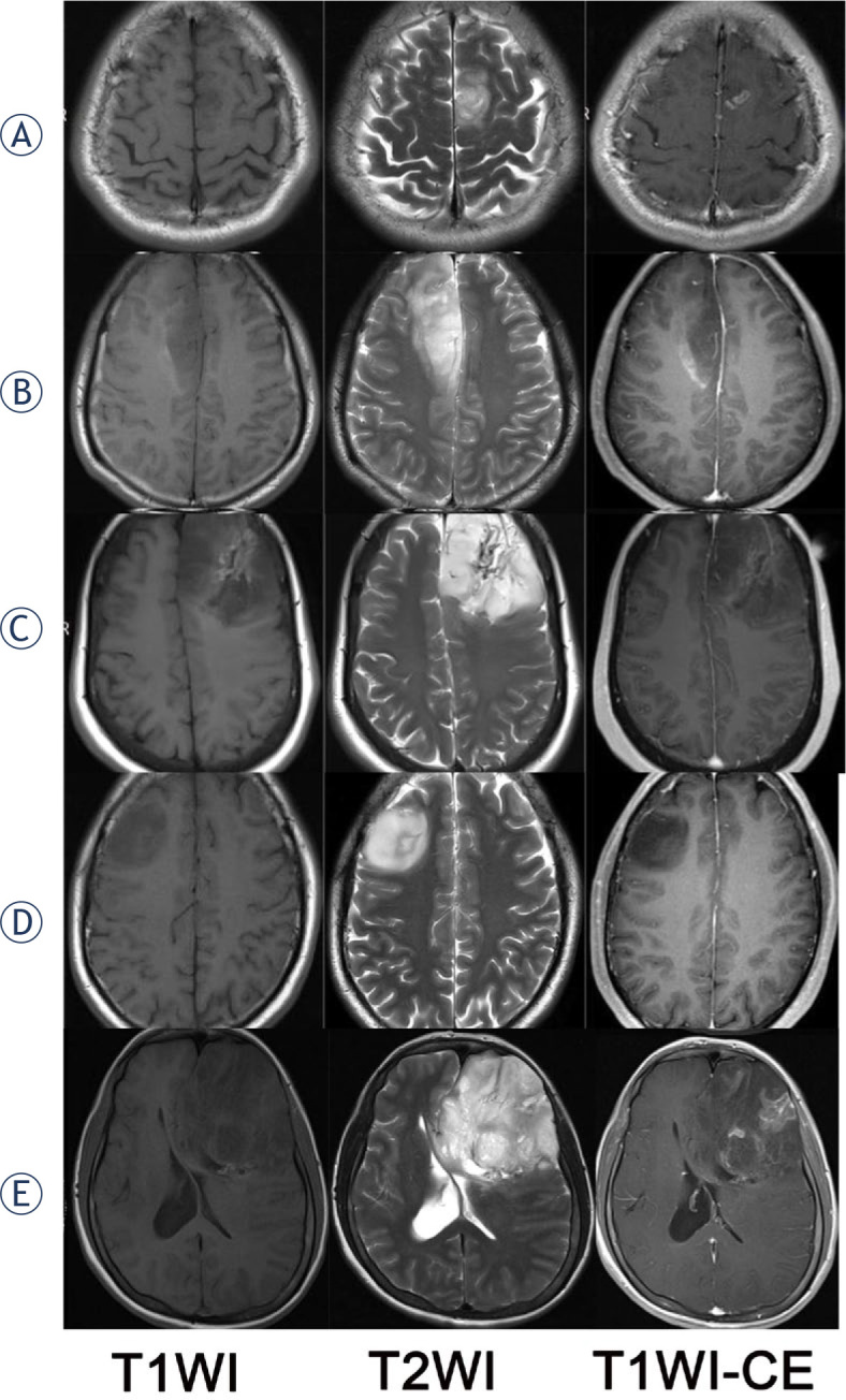 Looking through the imaging perspective: the importance of imaging necrosis in glioma diagnosis and prognostic prediction - single centre experience.