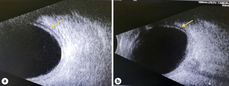 Transient Myopia and Ciliochoroidal Effusion following Influenza Vaccination.