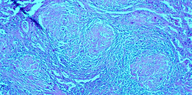 [Hepatosplenic sarcoidosis: description of a case at the University hospital center of Brazzaville, Congo].