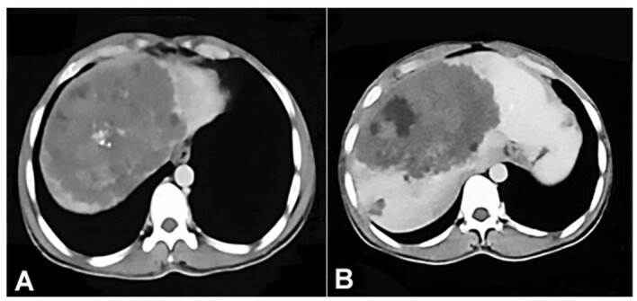 Hepatic alveolar echinococcosis simulating metastatic malignancy.