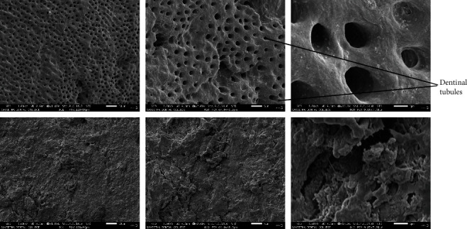 Comparative Evaluation of Antimicrobial and Smear Layer Removal Efficacy of <i>Mangifera indica</i> Kernel Extract as Root Canal Irrigant in Primary Molar: An In Vitro Study.