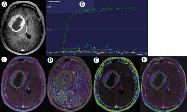 Looking through the imaging perspective: the importance of imaging necrosis in glioma diagnosis and prognostic prediction - single centre experience.