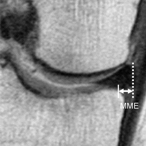 Superior outcomes of pullout repairs for medial meniscus posterior root tears in partial tear compared to complete radial tear.