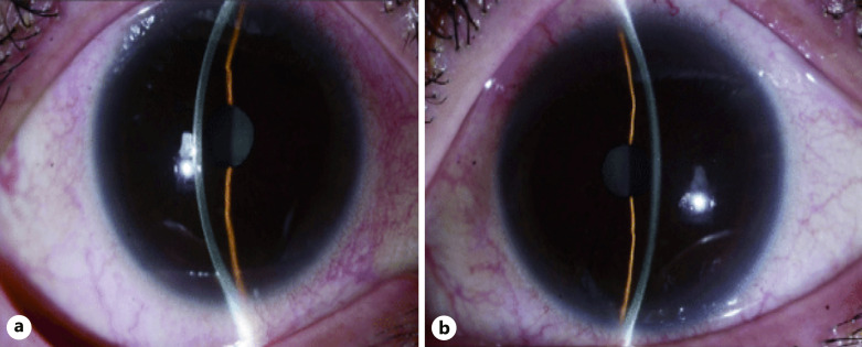 Transient Myopia and Ciliochoroidal Effusion following Influenza Vaccination.