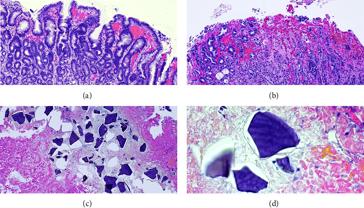 Upper Gastrointestinal Bleeding Secondary to Sodium Polystyrene Sulfonate Use: A Rare Adverse Effect of Commonly Prescribed Treatment.
