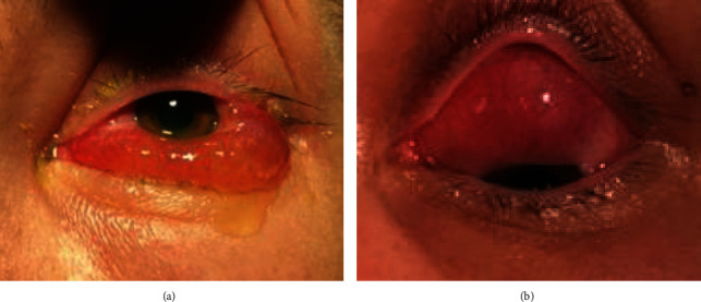 Isolated Ocular Relapse of Acute Myeloid Leukaemia Post Allogeneic Stem Cell Transplant.