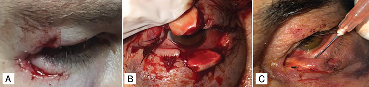 Demographic, Etiological, and Clinical Characteristics of Eyelid Lacerations.