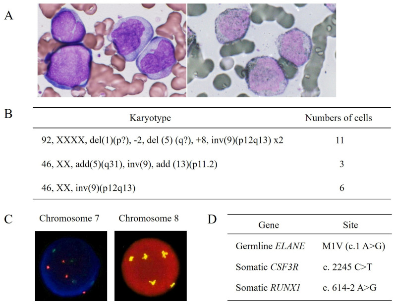 Successful Bone Marrow Transplantation in a Patient with Acute Myeloid Leukemia Developed from Severe Congenital Neutropenia Using Modified Chemotherapy and Conditioning Regimen for Leukemia.