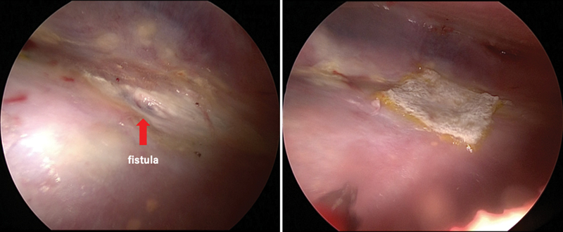 Pedicled Omentoplasty for Treatment of Rheumatoid Nodule Pneumothorax: A Case Report.