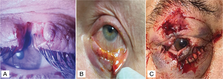 Demographic, Etiological, and Clinical Characteristics of Eyelid Lacerations.