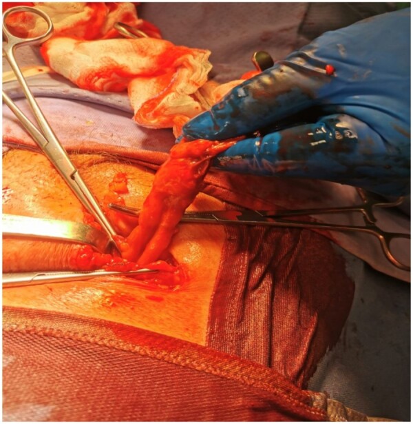 A rare case of De Garengeot hernia: CT findings.