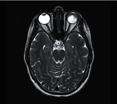 Isolated Ocular Relapse of Acute Myeloid Leukaemia Post Allogeneic Stem Cell Transplant.