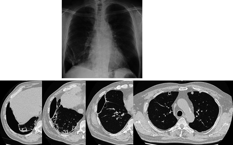 Pedicled Omentoplasty for Treatment of Rheumatoid Nodule Pneumothorax: A Case Report.