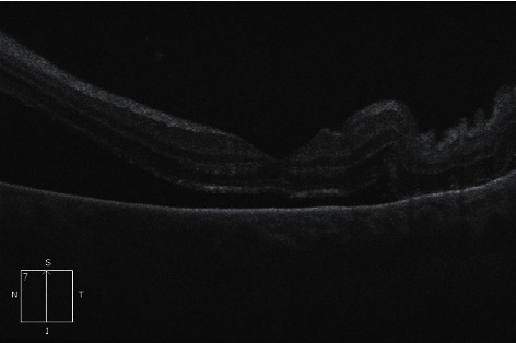 Isolated Ocular Relapse of Acute Myeloid Leukaemia Post Allogeneic Stem Cell Transplant.
