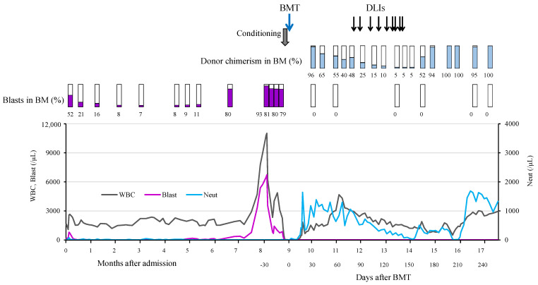 Successful Bone Marrow Transplantation in a Patient with Acute Myeloid Leukemia Developed from Severe Congenital Neutropenia Using Modified Chemotherapy and Conditioning Regimen for Leukemia.
