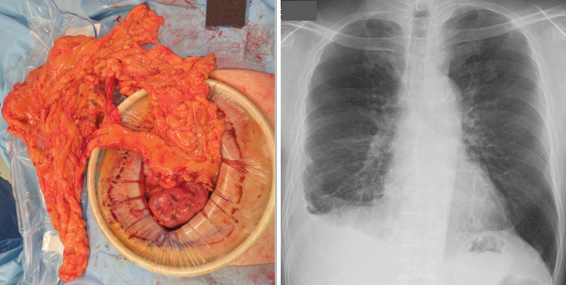 Pedicled Omentoplasty for Treatment of Rheumatoid Nodule Pneumothorax: A Case Report.