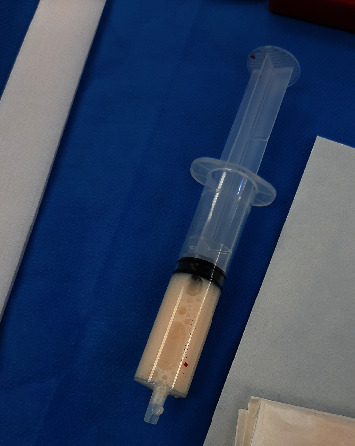 Acute Abdomen in Pregnancy due to Idiopathic Chylous Ascites.