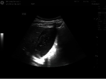 Acute Abdomen in Pregnancy due to Idiopathic Chylous Ascites.