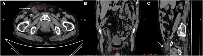 A rare case of De Garengeot hernia: CT findings.
