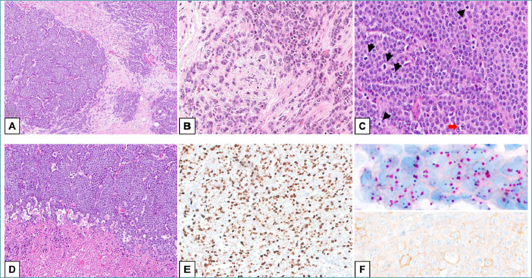 Pleomorphic/solid lobular carcinoma of male breast with PALB2 germline mutation: case report and literature review.