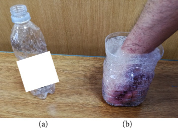 Carpometacarpal Osteoarthritis Pain of the Thumb Can Be Relieved by Commercial Beverage Carbonated Water.