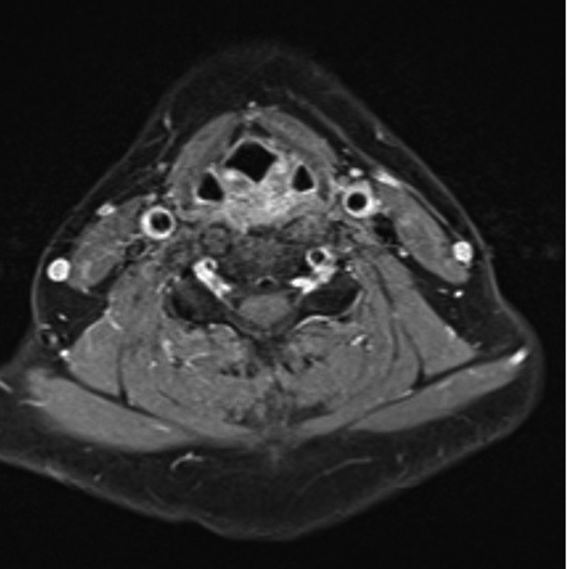 Transient Perivascular Inflammation of the Carotid Artery as a Poorly Recognized Cause of Neck Pain.
