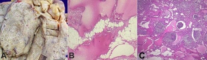 Mesenteric cystic lymphangioma in adults: a rare entity presenting as acute abdomen - a report of two cases.