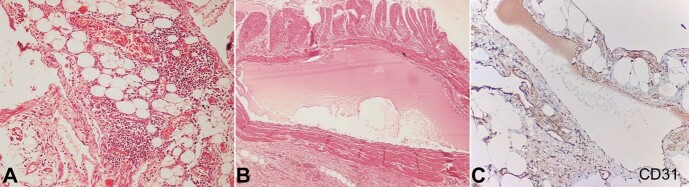 Mesenteric cystic lymphangioma in adults: a rare entity presenting as acute abdomen - a report of two cases.