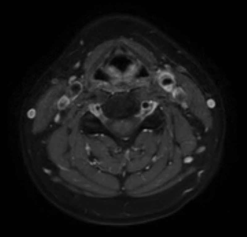 Transient Perivascular Inflammation of the Carotid Artery as a Poorly Recognized Cause of Neck Pain.