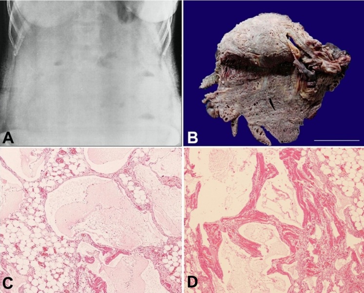 Mesenteric cystic lymphangioma in adults: a rare entity presenting as acute abdomen - a report of two cases.