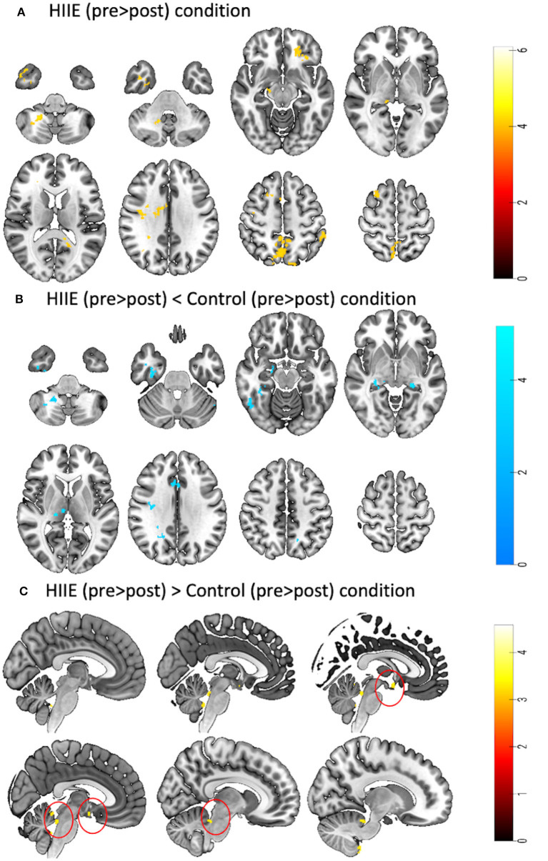 Fractional amplitude of low-frequency fluctuations associated with μ-opioid and dopamine receptor distributions in the central nervous system after high-intensity exercise bouts.