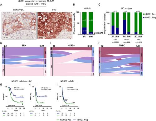 NDRG1 is a prognostic biomarker in breast cancer and breast cancer brain metastasis