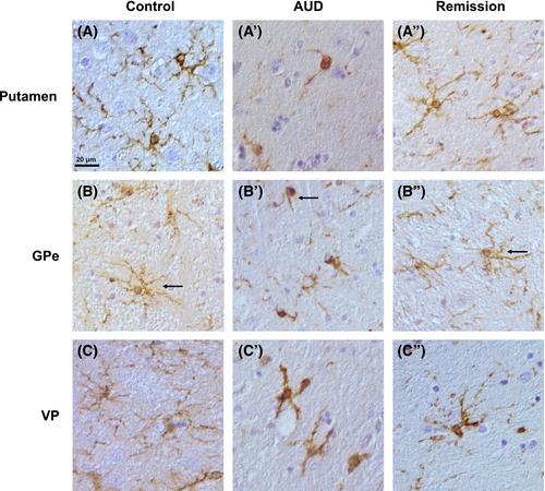 Microglia activity in the human basal ganglia is altered in alcohol use disorder and reversed with remission from alcohol