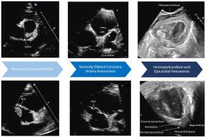 Coronary Artery Aneurysm Rupture in Kawasaki Disease and SARS-CoV-2 Infection