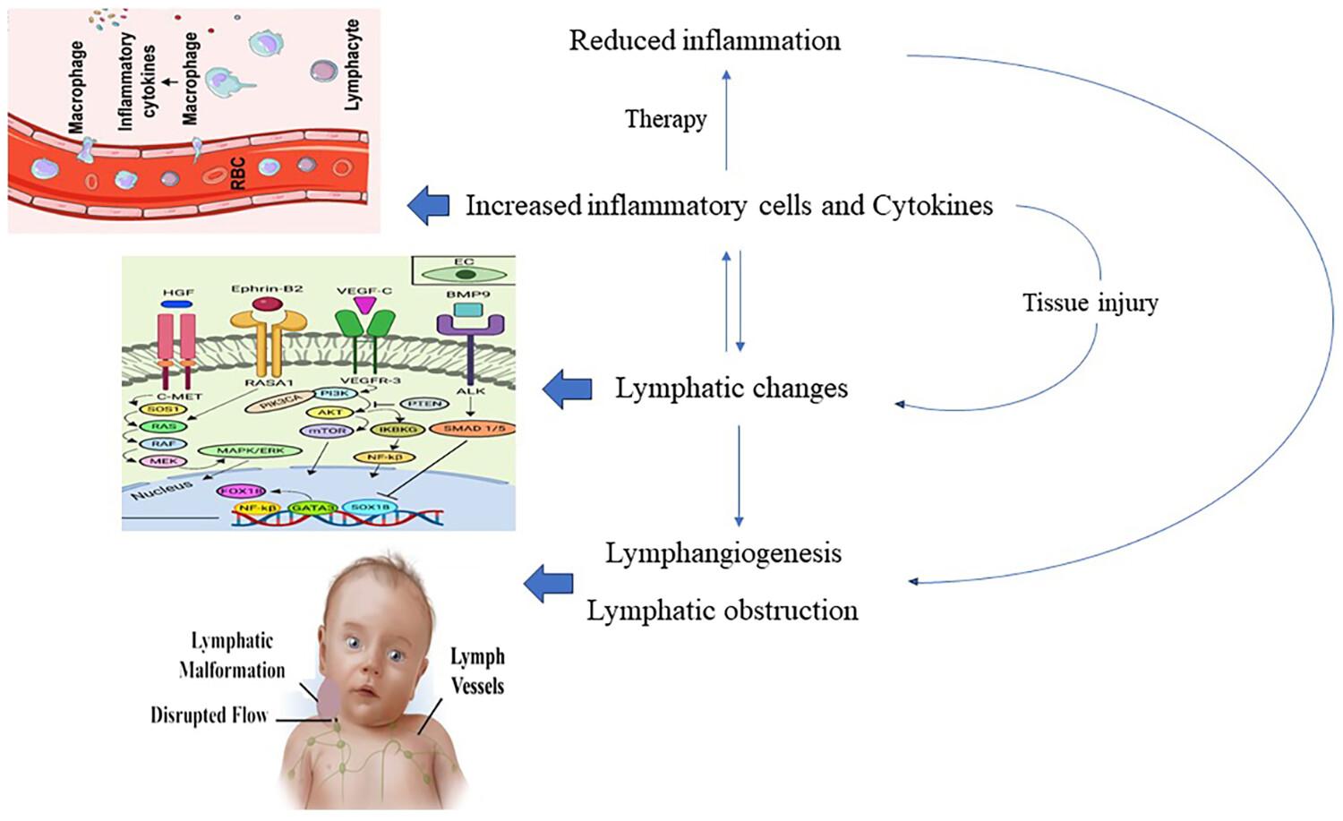 The role of key biomarkers in lymphatic malformation: An updated review