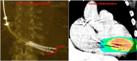 Characterizing cardiac contractile motion for noninvasive radioablation of ventricular tachycardia