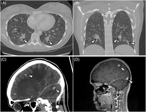 Epithelioid hemangioendothelioma (EHE) with WWTR1::TFE3 gene fusion, a novel fusion variant