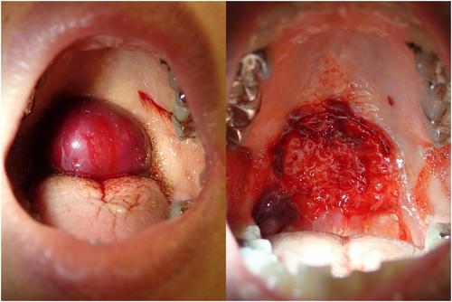 Gigantic angina bullosa haemorrhagica in the oropharynx